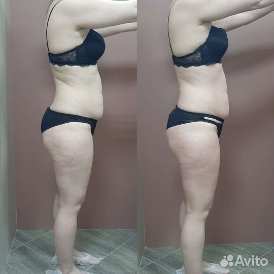 Липопластика тела (ручная коррекция фигуры)