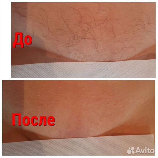 Шугаринг /Депиляция воском/Челябинск Северо запад