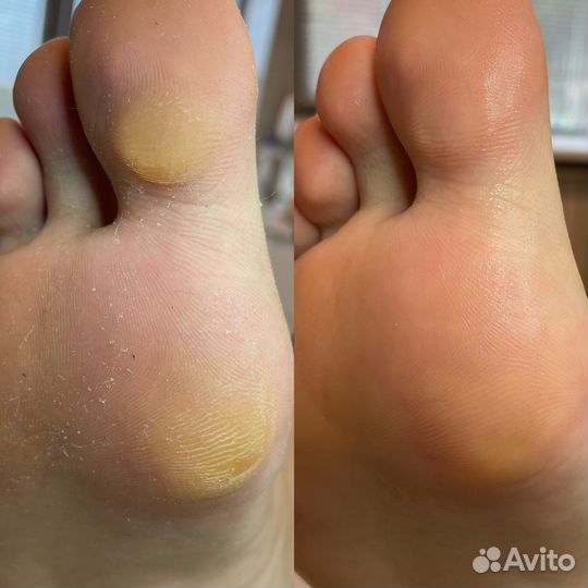 Педикюр Аппартный