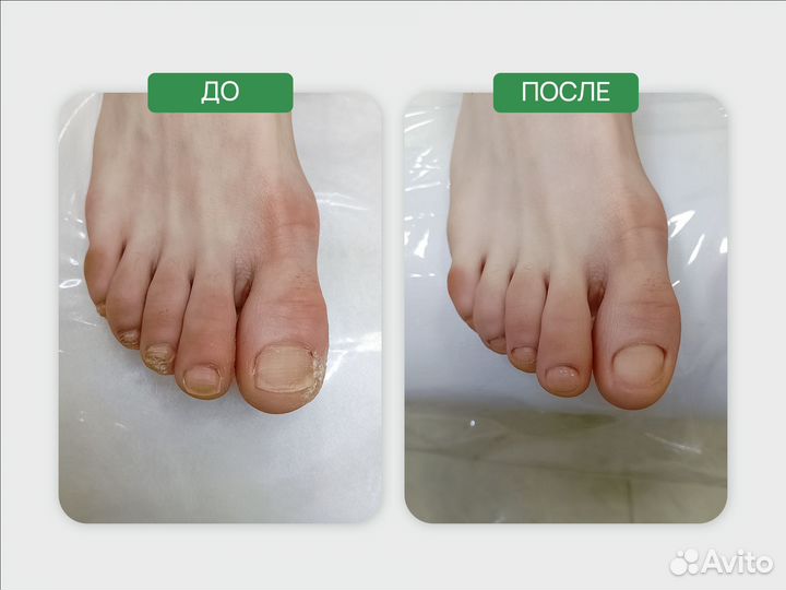 Подолог, вросшие ногти, медицинский педикюр