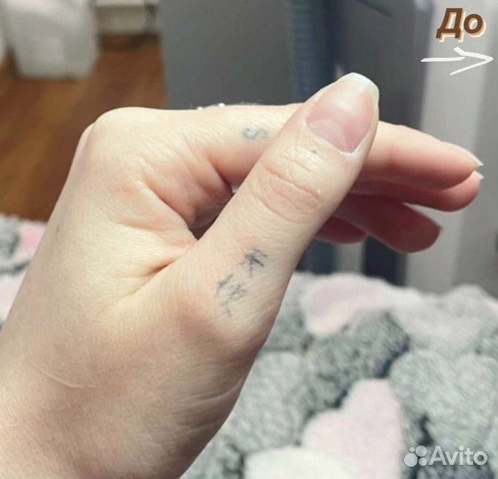 Удаление шрамов, тату lazer pico