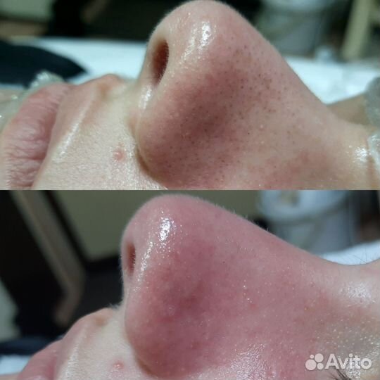 Чистка лица