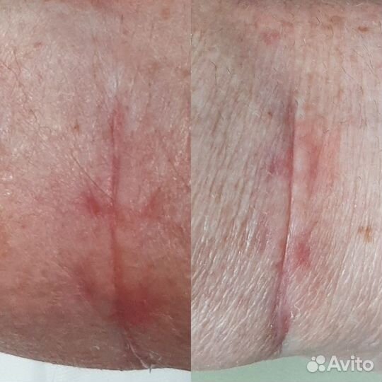 Удаление шрамов и рубцов