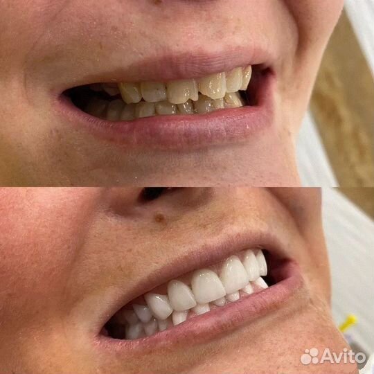 Съемное и несъемное протезирование в Акуле