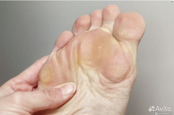 Удаление стержневых мозолей