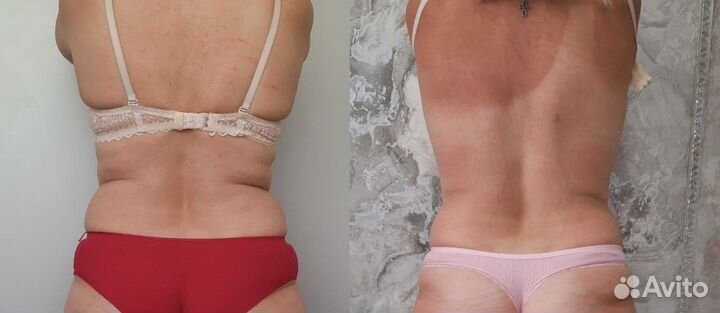 Массаж коррекция фигуры массажем