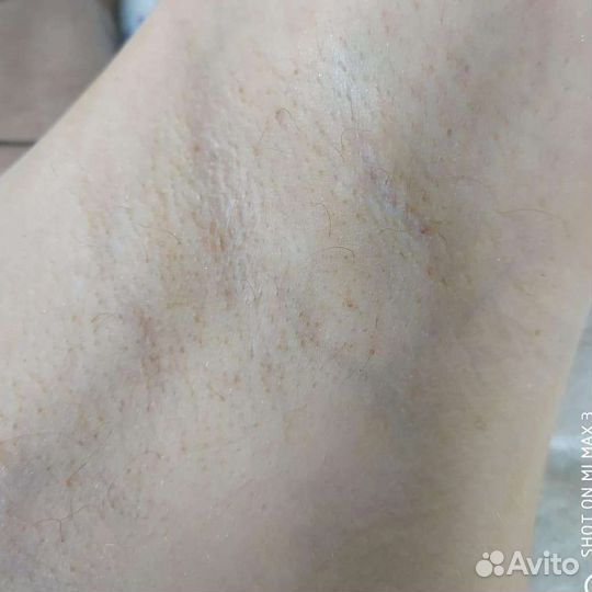 Электроэпиляция на apilus (апилус)