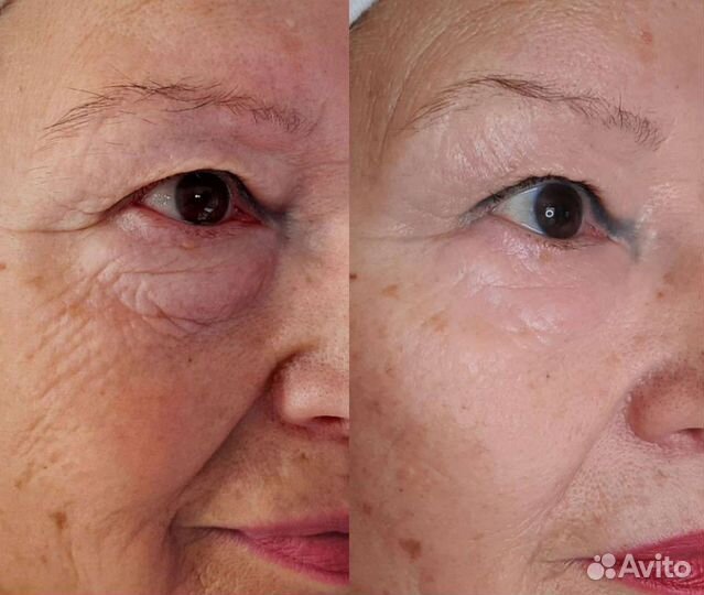 Контурная пластика