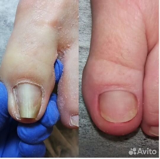 Подолог Педикюр