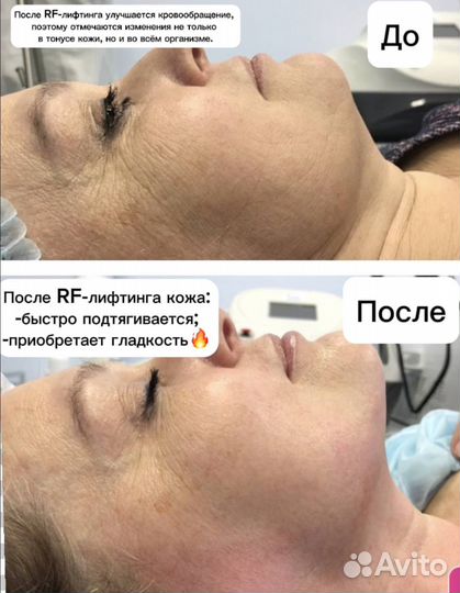 Косметолог Чистка лица Пилинг