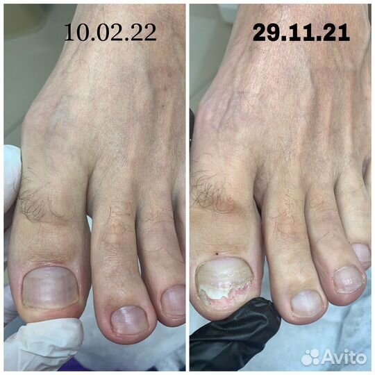 Медицинский педикюр. Подолог