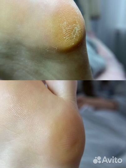 Подолог лечебный педикюр титановая нить