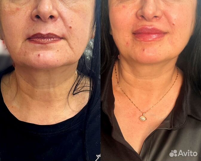 СМАС лифтинг подтяжка лица