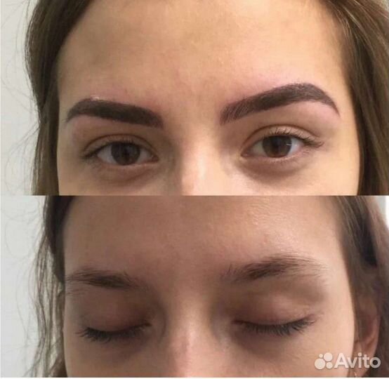 Ремувер, удаление татуажа/тату