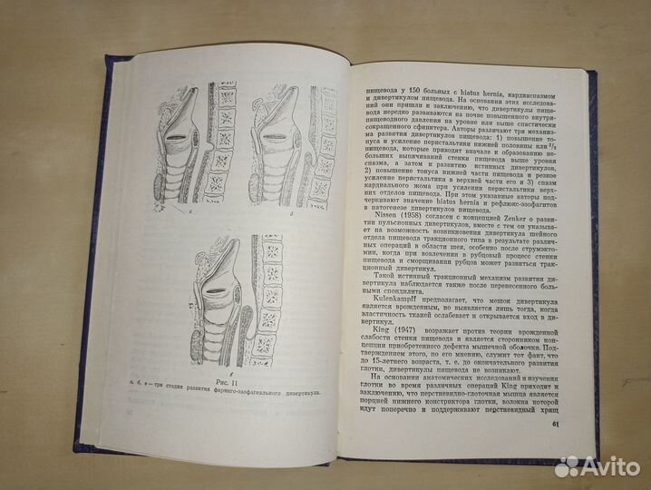 Дивертикулы пищевода. Петровский. 1968