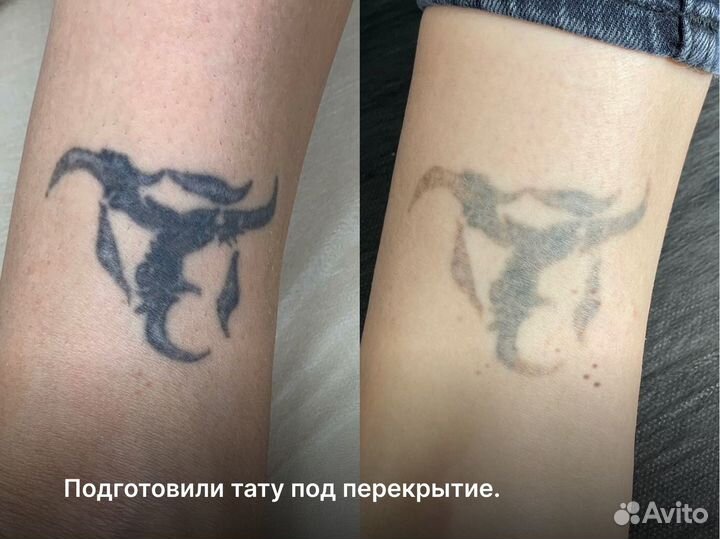 Лазерное удаление тату