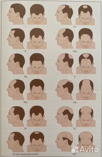 Пересадка волос методом FUE