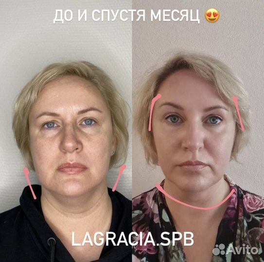 Модель SMAS lifting