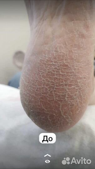 Средство для удаления натоптышей и мазолей