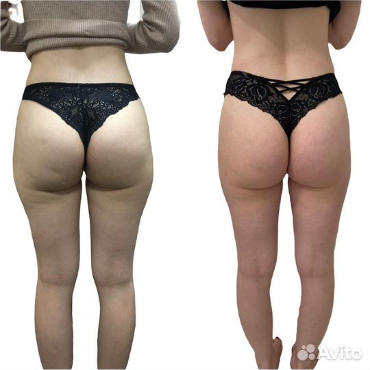 Обучение ручной липосакции