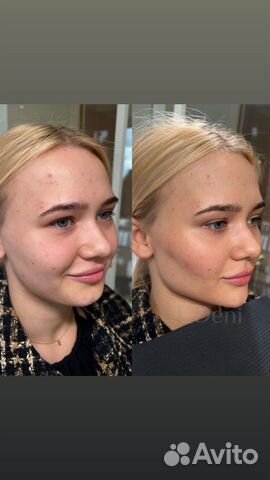 Губы, Ботокс Full Face Косметолог Требуются модели