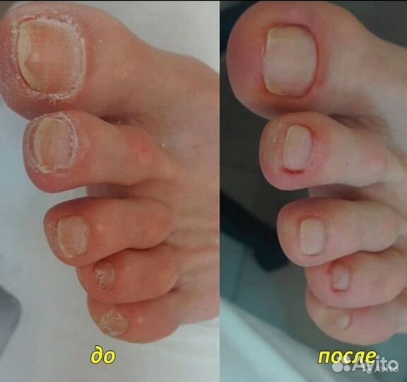 Медицинский педикюр подолог