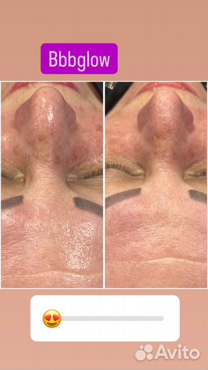 Фракционная мезотерапия/микронидлинг/bbglow