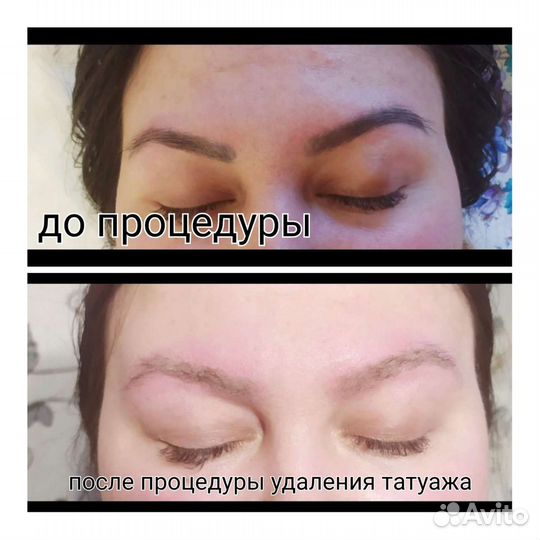 Удаление тату и татуажа лазером, карбоновый пилинг