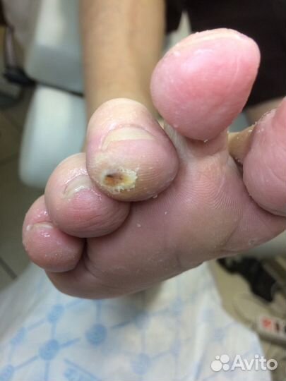 Медицинский педикюр, подолог, выезд на дом