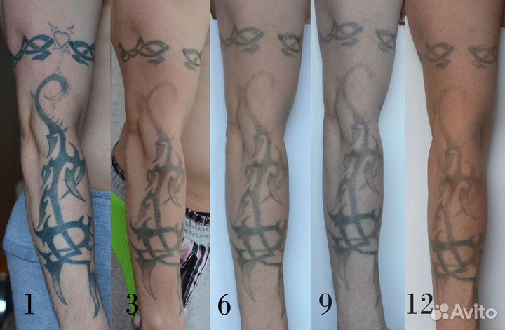 Лазер для удаления татуировок