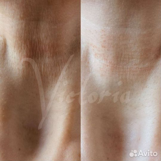 Косметология. уз Чистка. Rf лифтинг