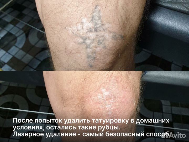 Лазерное удаление тату