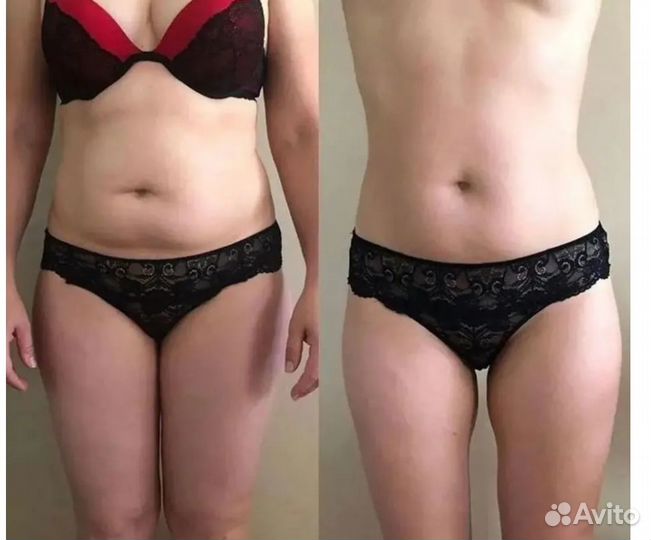 Удаление жира, криолиполиз в Белгороде