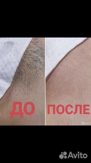 Элос-эпиляция: глубокое бикини