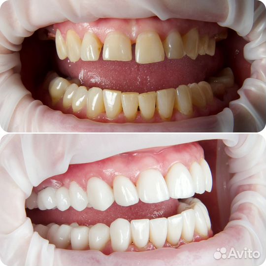 Зубной техник Виниры Коронки