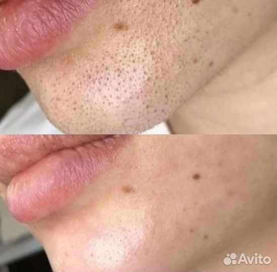 Чистка лица