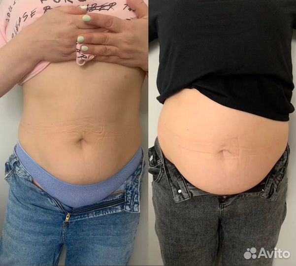 Плоский живот - размер за 1 процедуру
