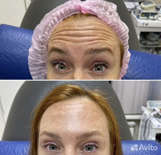 Ботокс (Бутулинотерапия) botox