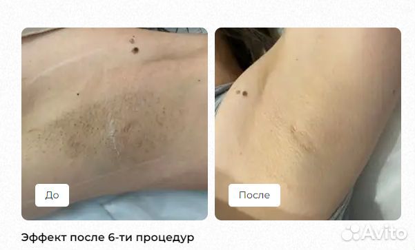 Лазерная эпиляция в Питере