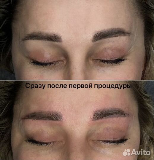 Удаление перманента татуажа