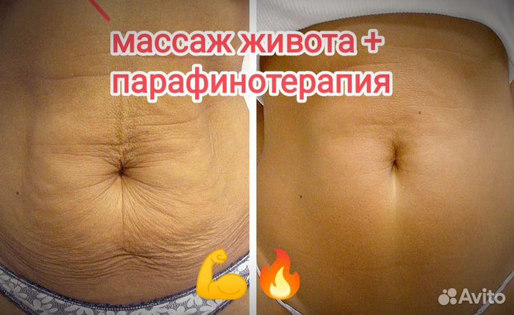 Антицеллюлитный массаж