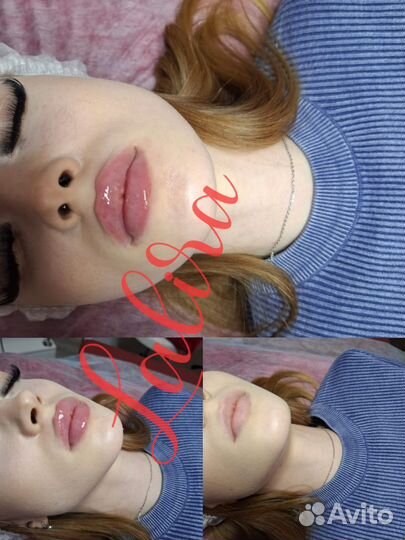 Косметолог. Увеличение губ. Удаление филлера