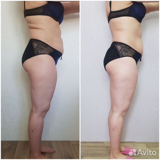 Прессотерапия