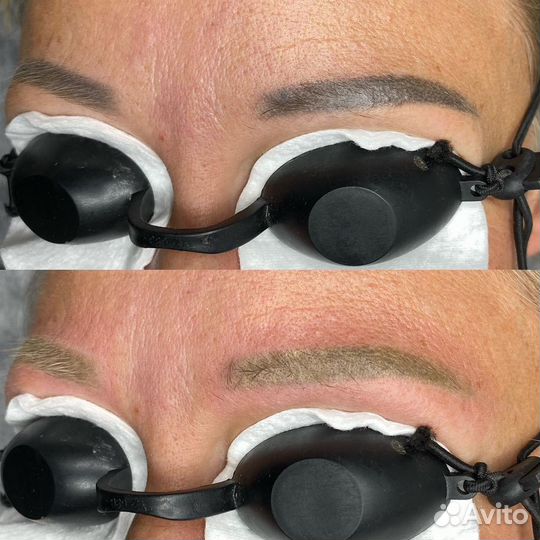 Удаление перманентного макияжа