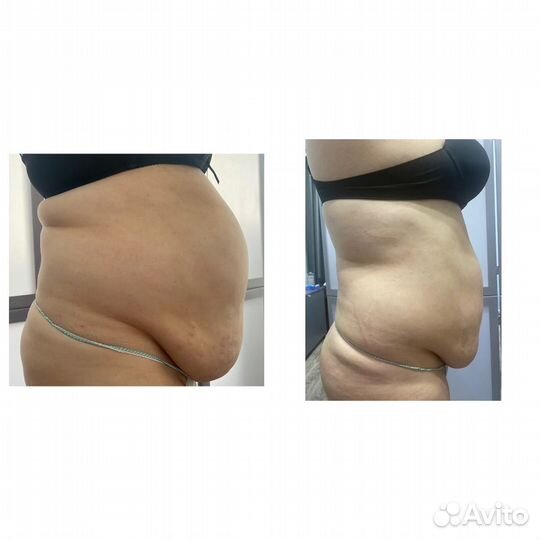 Коррекция фигуры