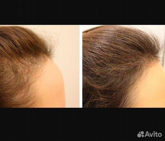 Сыворотка против выпадения волос