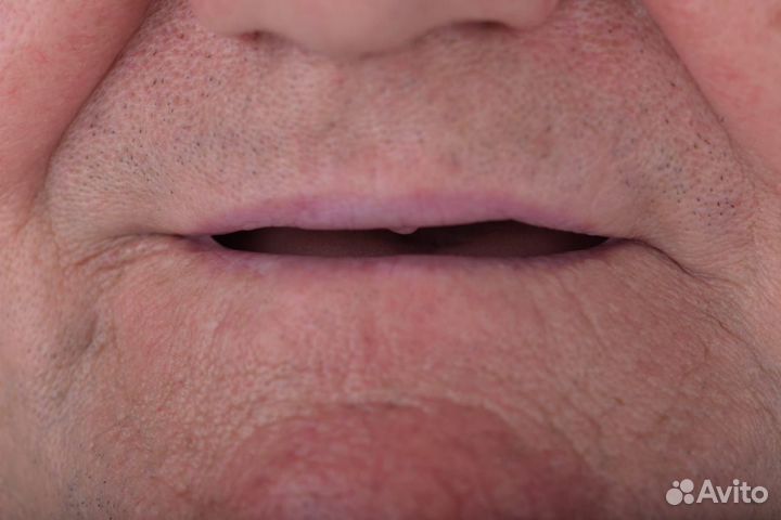 Зубные протезы