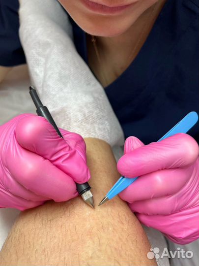 Обучение электроэпиляции