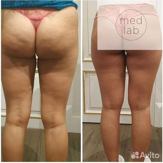 Аппарат мини Кавитация, липолазер, RF, кавакуум