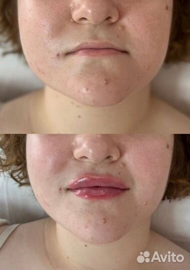 Увеличение губ